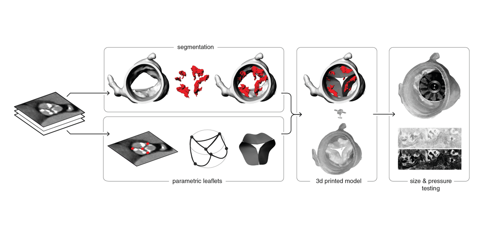 pre-procedural-fit-testing-transcatheter-aortic-valve-replacement-tavr-valves-using-parametric-modeling-3d-printing-1 pre-procedural-fit-testing-transcatheter-aortic-valve-replacement-tavr-valves-using-parametric-modeling-3d-printing-1